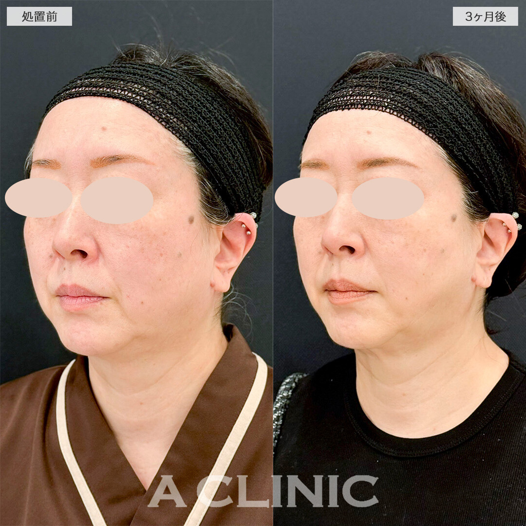 1day小顔脂肪吸引であご下のぼやけた感じが改善！処置前と3ヶ月後の症例です(50代女性)