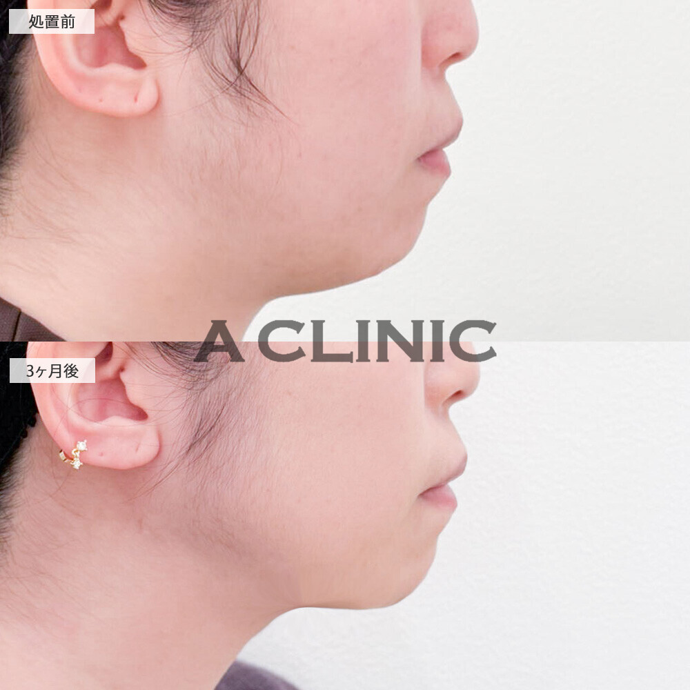 1day小顔脂肪吸引であご下のぷにぷに撃退！処置前から3ヶ月後の症例です(30代女性)