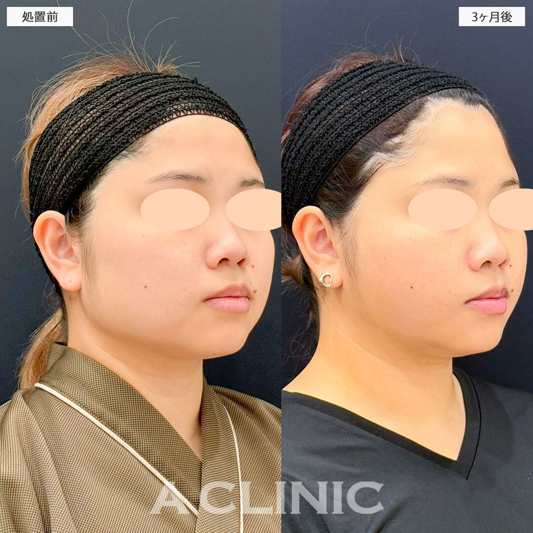 1day小顔脂肪吸引と小顔エラボトックスで輪郭の張り出しが改善しました！こちら処置前と3ヶ月後の症例です(30代女性)