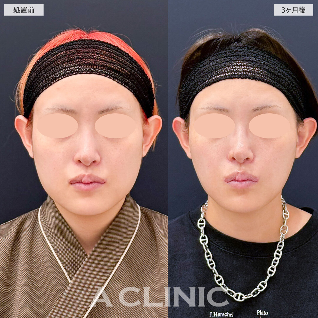 1day小顔と小顔エラボトックスで幼い頃から悩んでいた輪郭とお別れ！こちら処置前と３ヶ月後の症例です(20代女性)