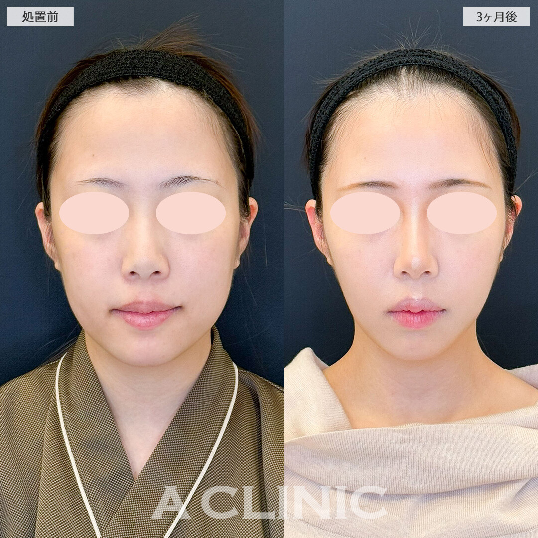 1day小顔脂肪吸引と小顔エラボトックスで顔の横幅がシュッとしました！こちら処置前と3ヶ月後の症例です(20代女性)