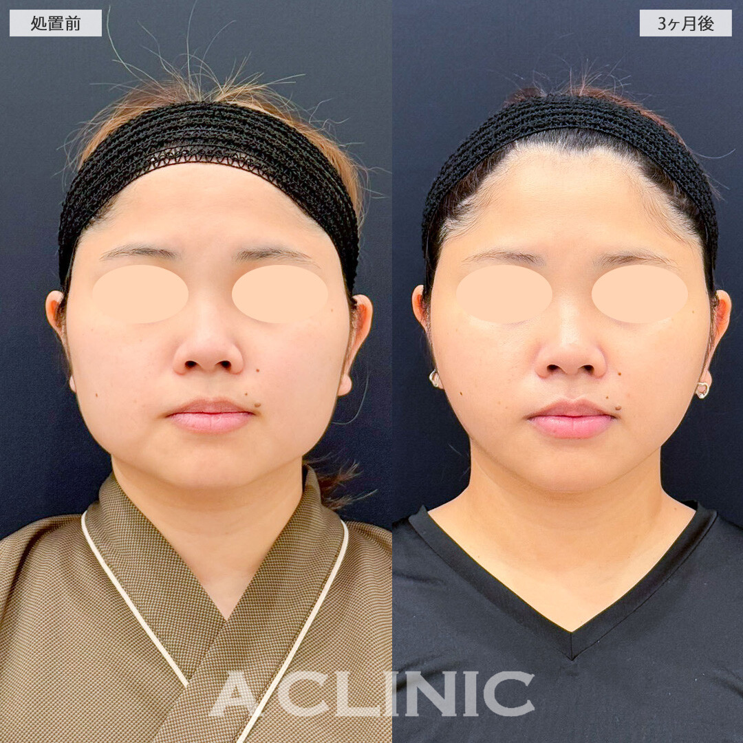 1day小顔脂肪吸引と小顔エラボトックスで輪郭の張り出しが改善しました！こちら処置前と3ヶ月後の症例です(30代女性)