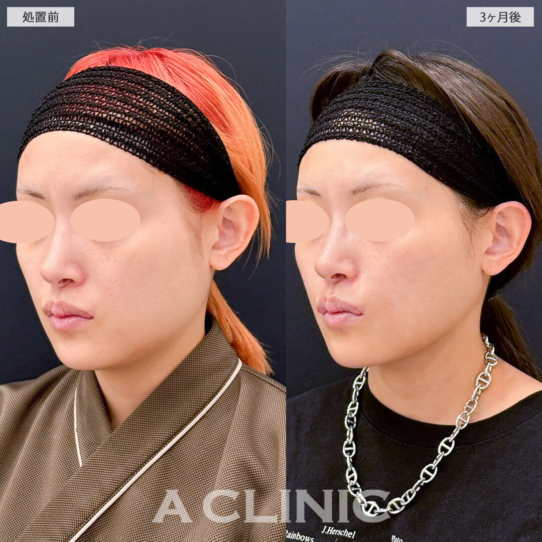 1day小顔と小顔エラボトックスで幼い頃から悩んでいた輪郭とお別れ！こちら処置前と３ヶ月後の症例です(20代女性)