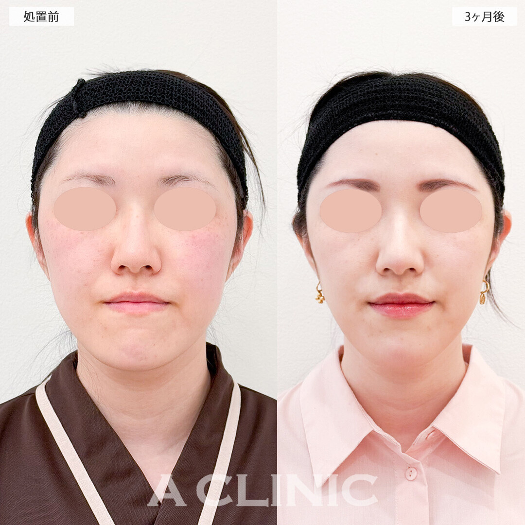 1day小顔脂肪吸引と小顔エラボトックスで更にスッキリした小顔に！処置前と3ヶ月後の症例です(30代女性)