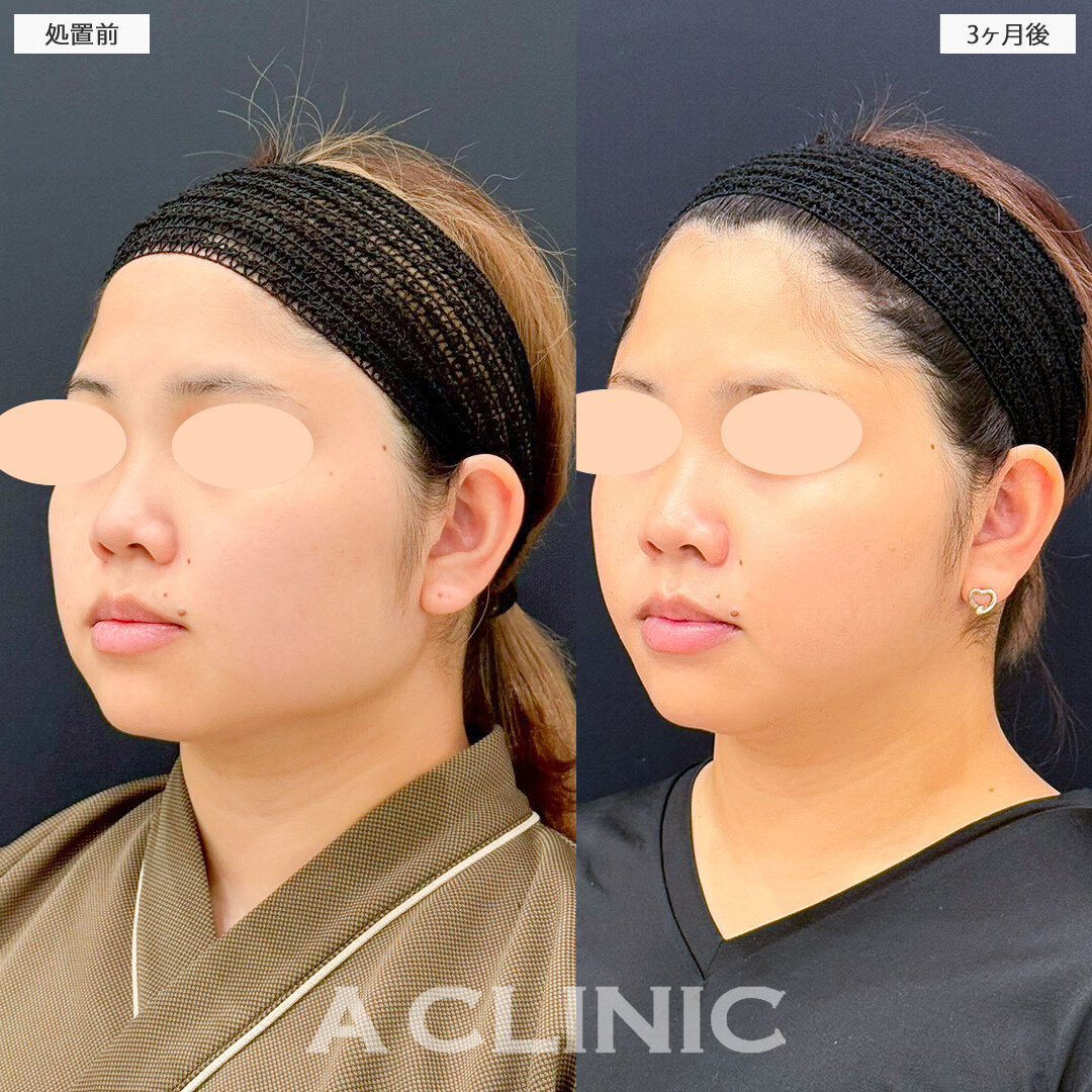1day小顔脂肪吸引と小顔エラボトックスで輪郭の張り出しが改善しました！こちら処置前と3ヶ月後の症例です(30代女性)