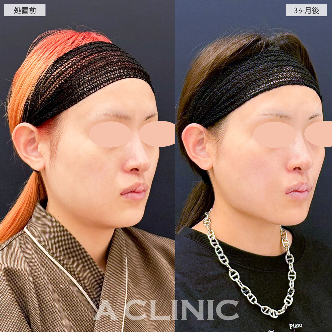 1day小顔と小顔エラボトックスで幼い頃から悩んでいた輪郭とお別れ！こちら処置前と３ヶ月後の症例です(20代女性)