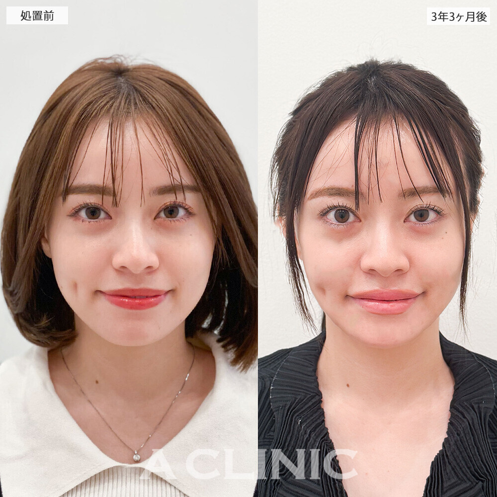1day小顔脂肪吸引で後戻りせずスッキリ輪郭続く！処置前と3年3ヶ月後の症例です(20代女性)