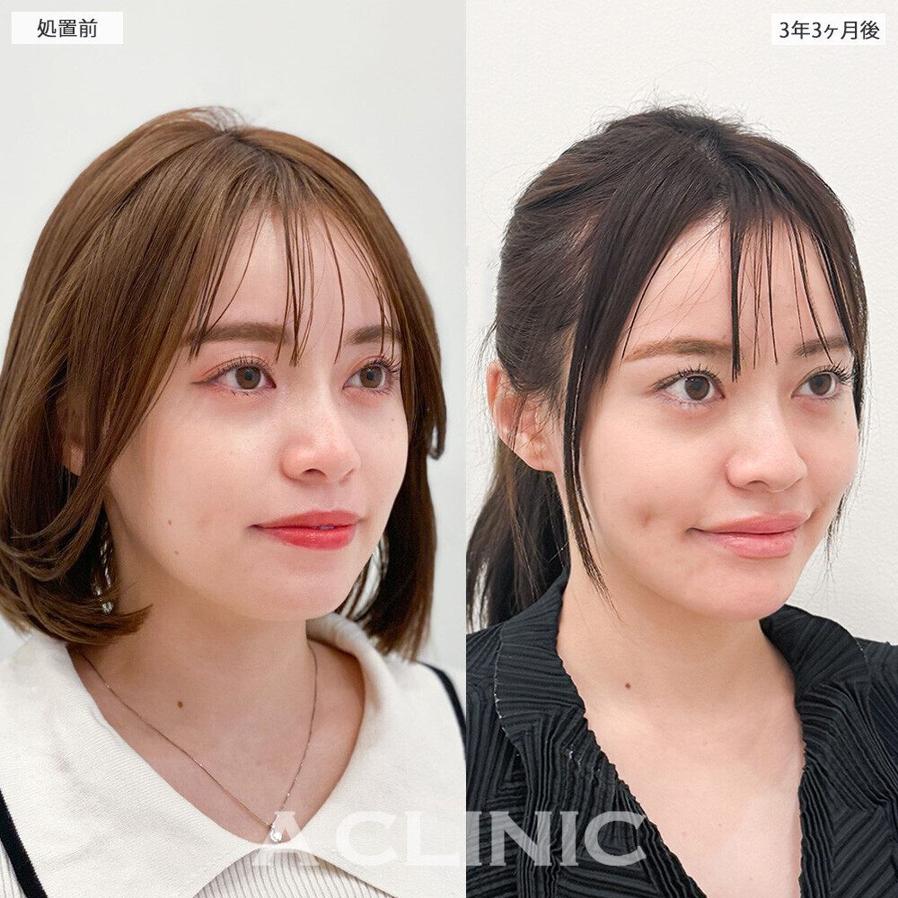1day小顔脂肪吸引で後戻りせずスッキリ輪郭続く！処置前と3年3ヶ月後の症例です(20代女性)