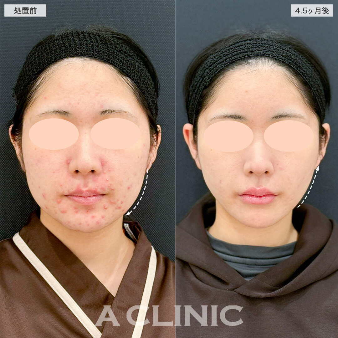 1day小顔脂肪吸引とイソトレチノインでお悩みを一度に解決！処置前と4ヶ月半後の症例です(10代女性)