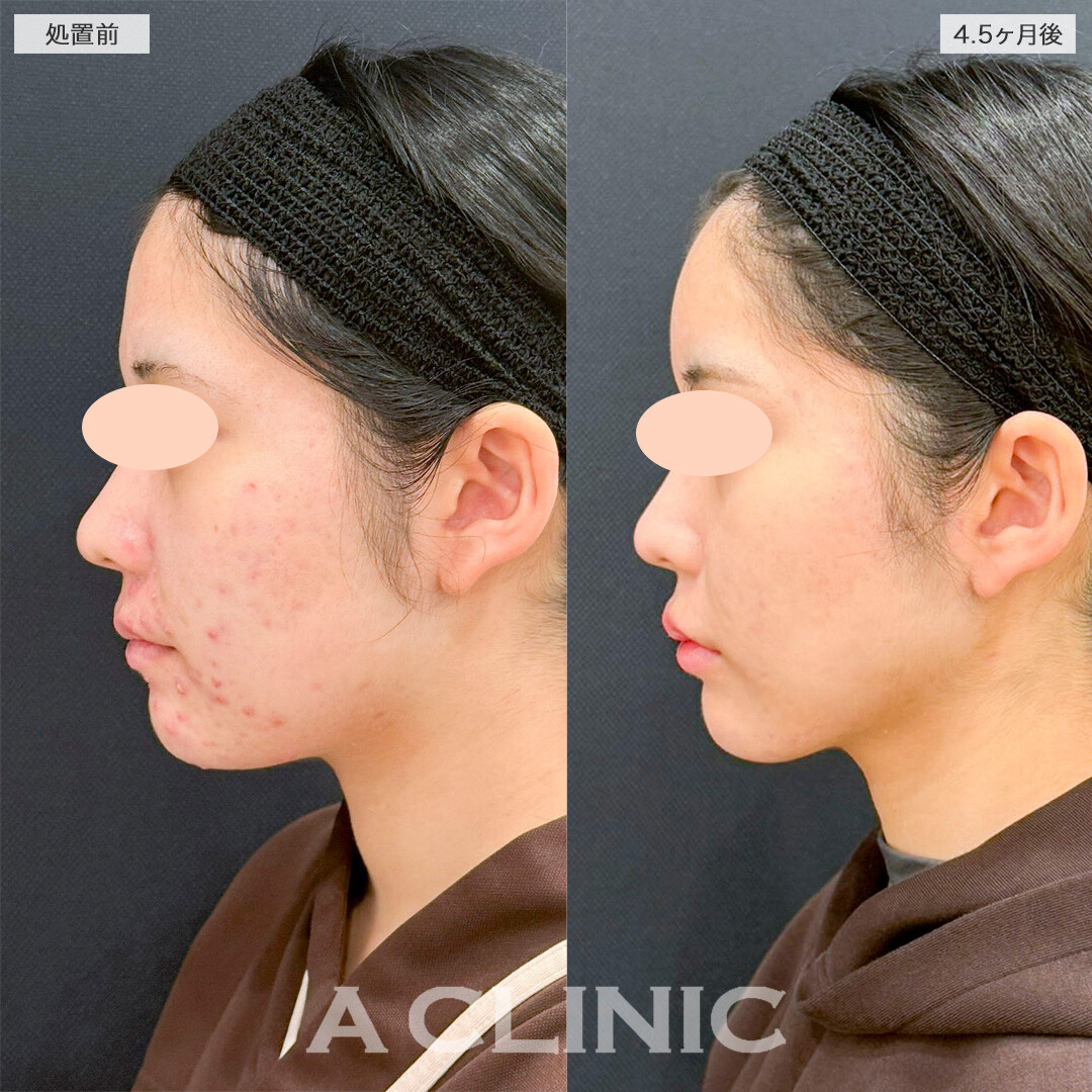 1day小顔脂肪吸引とイソトレチノインでお悩みを一度に解決！処置前と4ヶ月半後の症例です(10代女性)