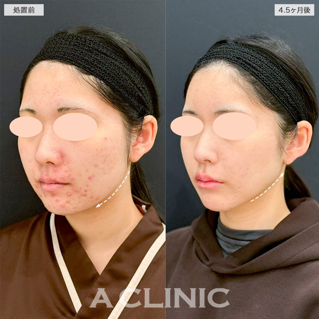 1day小顔脂肪吸引とイソトレチノインでお悩みを一度に解決！処置前と4ヶ月半後の症例です(10代女性)