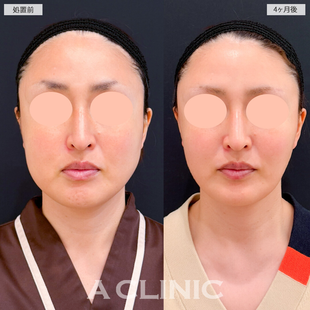 1day小顔脂肪吸引とバッカルファット除去術とA式美肌たるみ切開でフェイスラインのボリュームダウンに成功！処置前と4ヶ月後の症例です(30代女性)