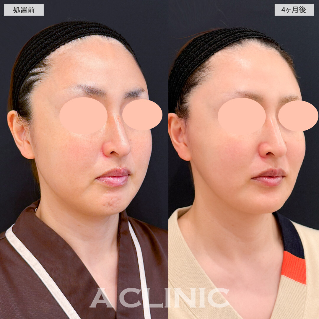 1day小顔脂肪吸引とバッカルファット除去術とA式美肌たるみ切開でフェイスラインのボリュームダウンに成功！処置前と4ヶ月後の症例です(30代女性)