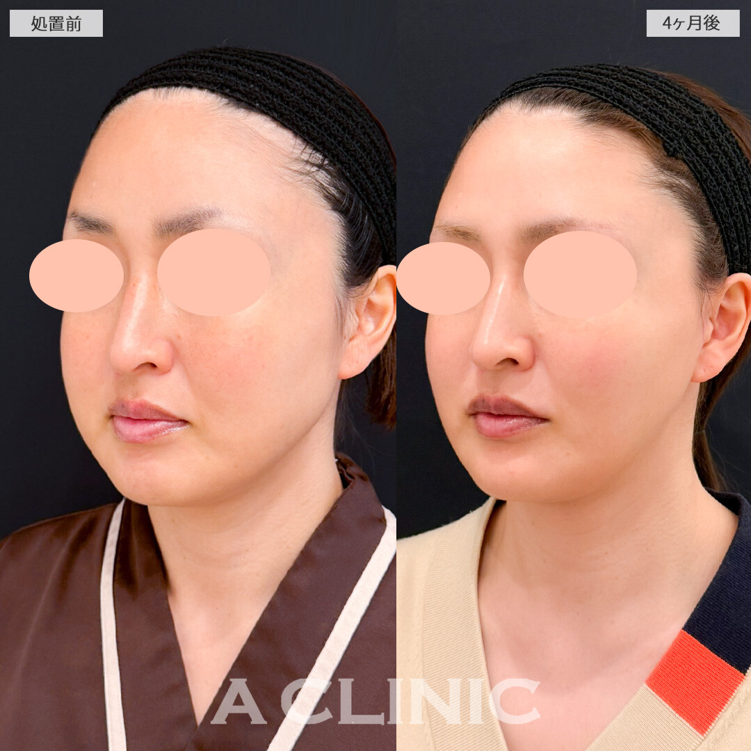 1day小顔脂肪吸引とバッカルファット除去術とA式美肌たるみ切開でフェイスラインのボリュームダウンに成功！処置前と4ヶ月後の症例です(30代女性)