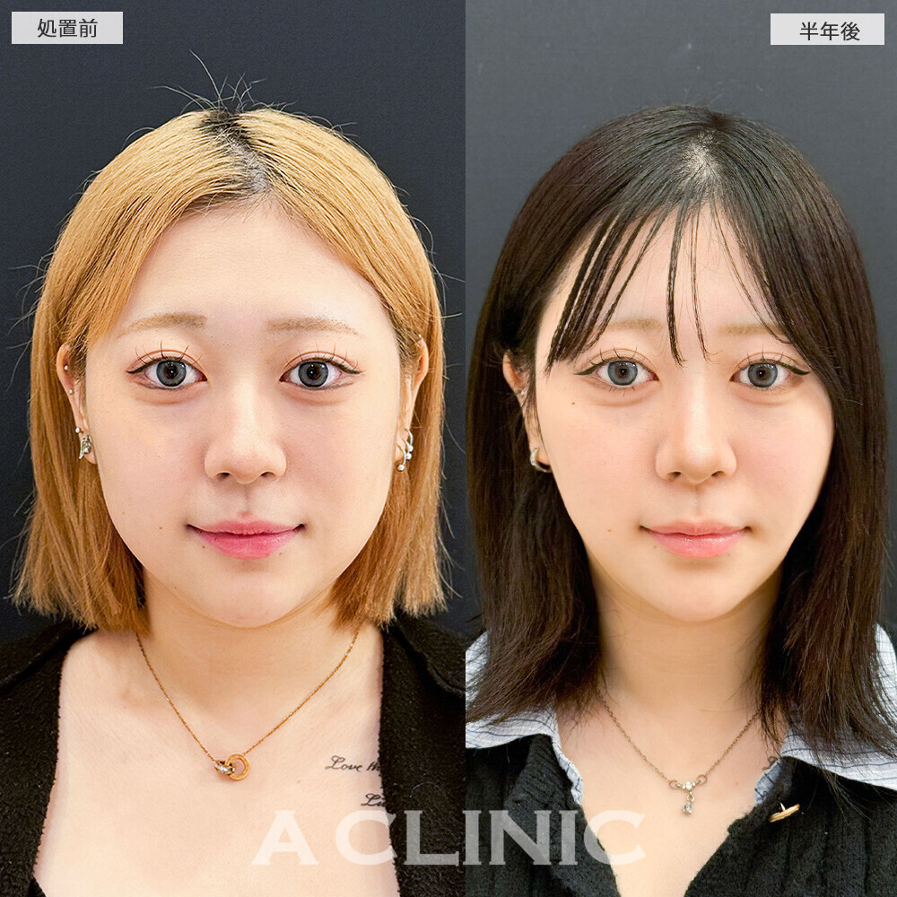 1day小顔脂肪吸引で後戻りせず小顔キープ！こちら処置前と半年後の症例です(10代女性)