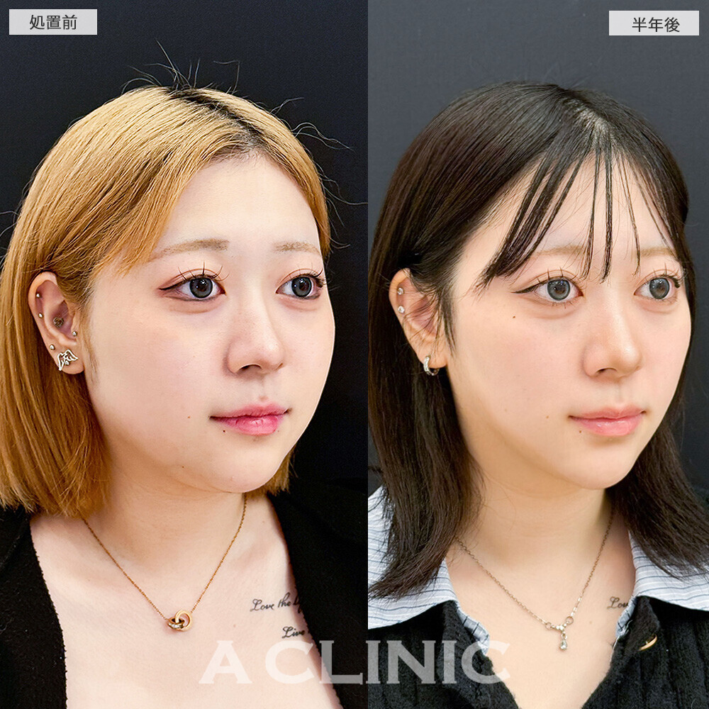 1day小顔脂肪吸引で後戻りせず小顔キープ！こちら処置前と半年後の症例です(10代女性)