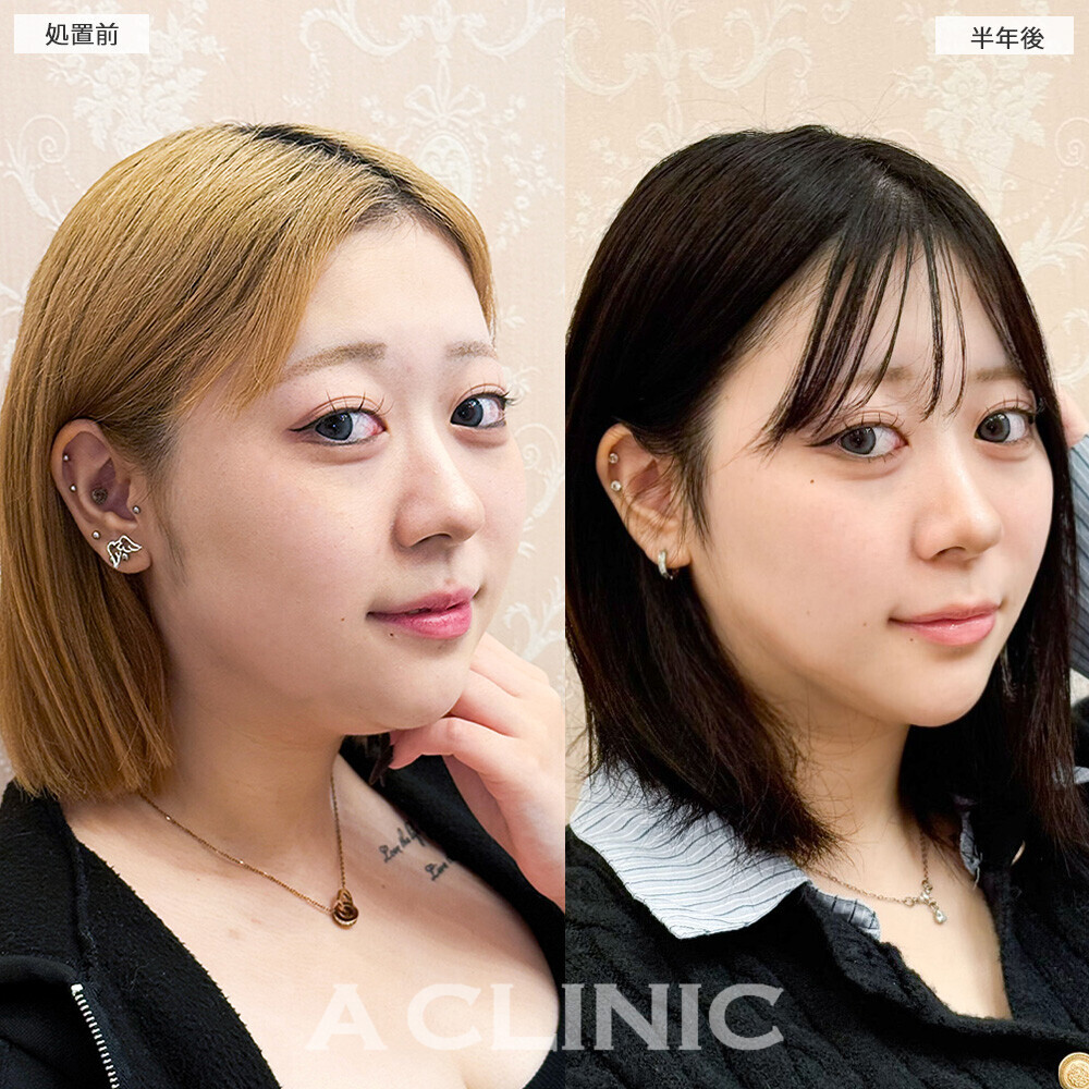 1day小顔脂肪吸引で後戻りせず小顔キープ！こちら処置前と半年後の症例です(10代女性)