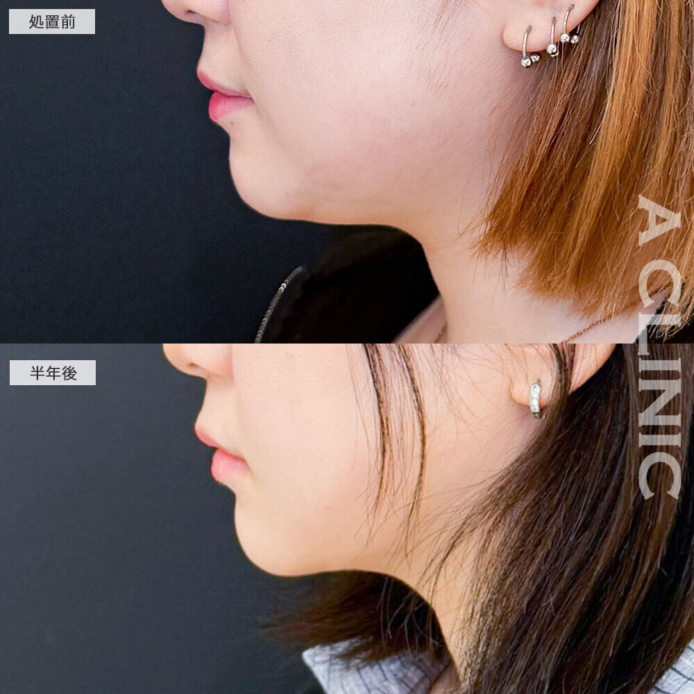 1day小顔脂肪吸引で後戻りせず小顔キープ！こちら処置前と半年後の症例です(10代女性)