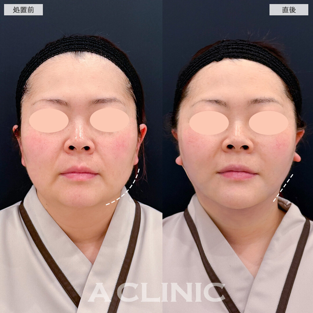 1day小顔脂肪吸引はダウンタイム最小限なので忙しいママさんにもおすすめ！こちら処置前と直後の症例です(40代女性)