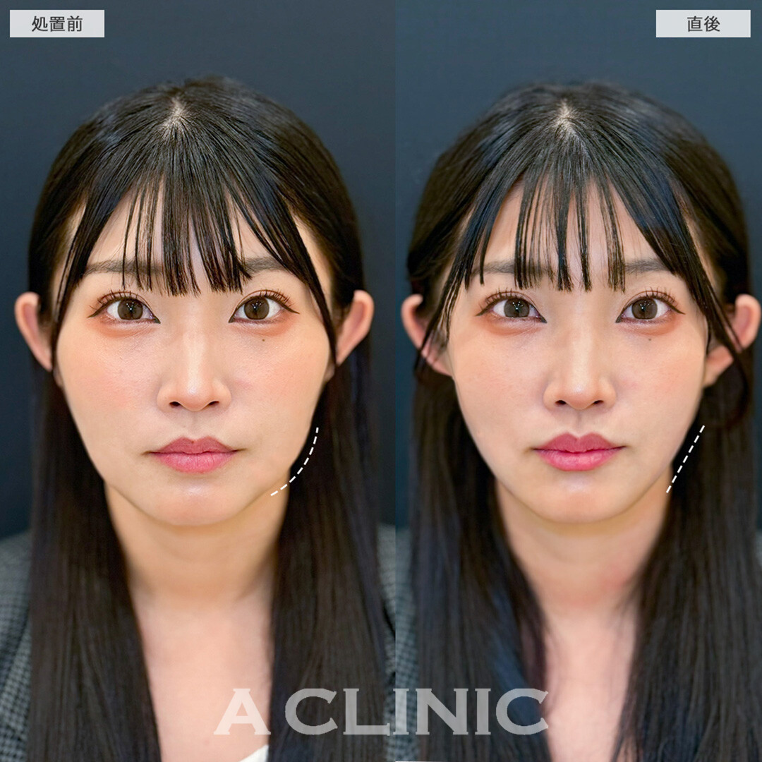 1day小顔脂肪吸引はダウンタイム最小限です！こちら処置前と直後の症例です(30代女性)