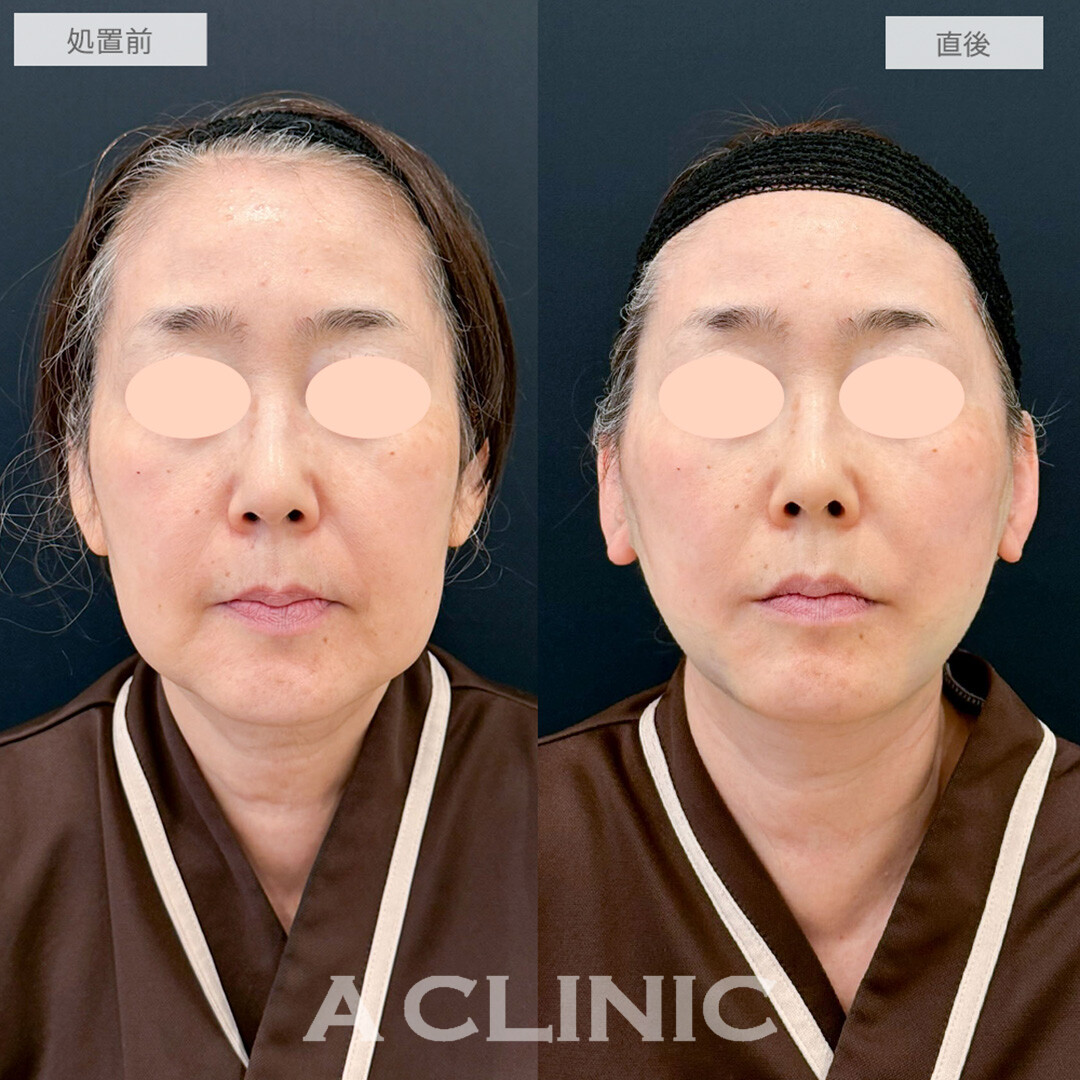 1day小顔脂肪吸引で脂肪の重みを取って若返り！こちら処置前と直後の症例です(60代女性)
