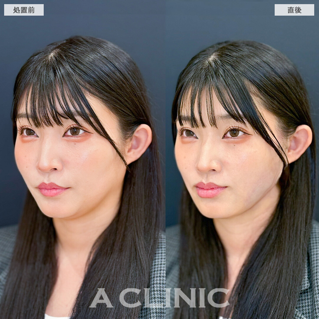 1day小顔脂肪吸引はダウンタイム最小限です！こちら処置前と直後の症例です(30代女性)