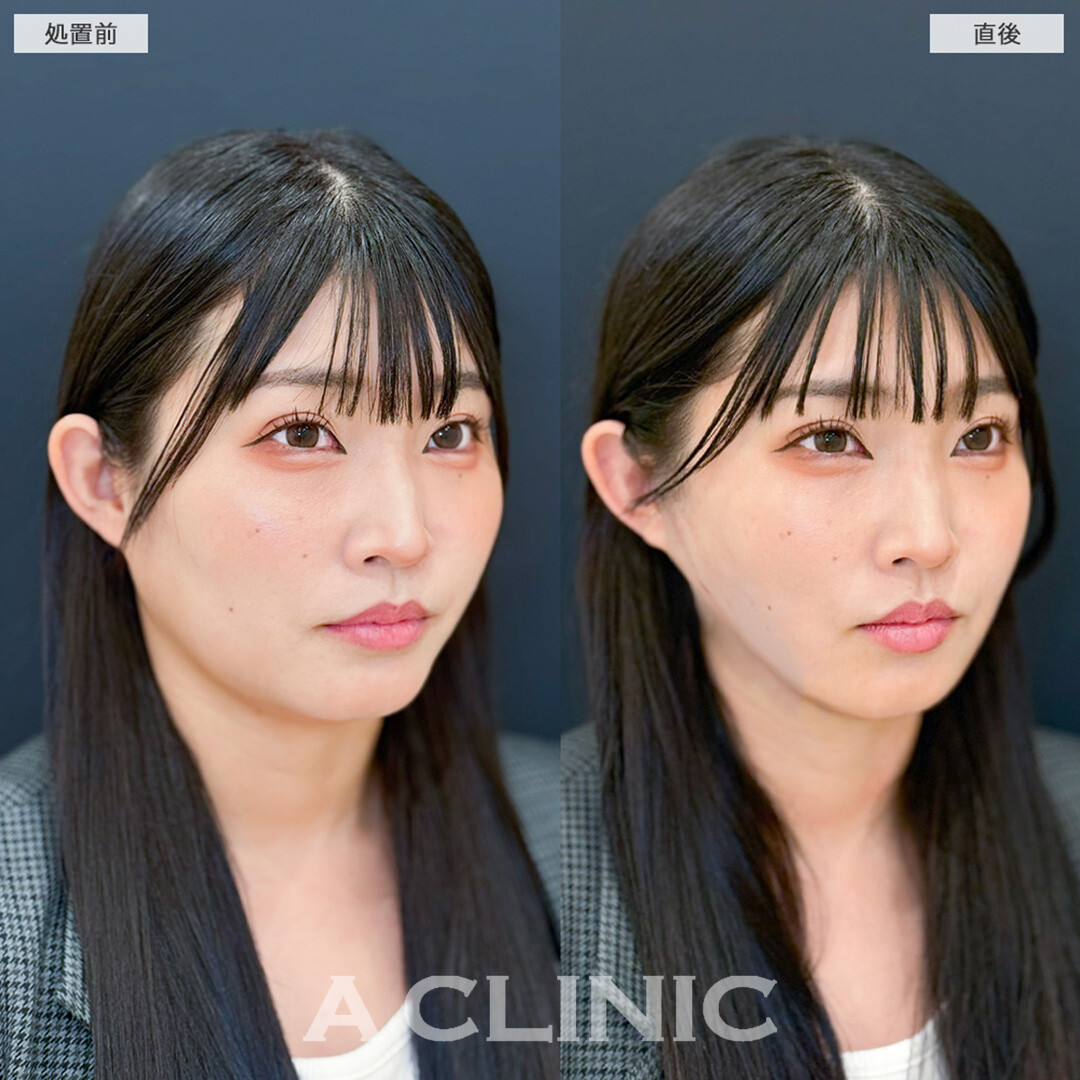 1day小顔脂肪吸引はダウンタイム最小限です！こちら処置前と直後の症例です(30代女性)