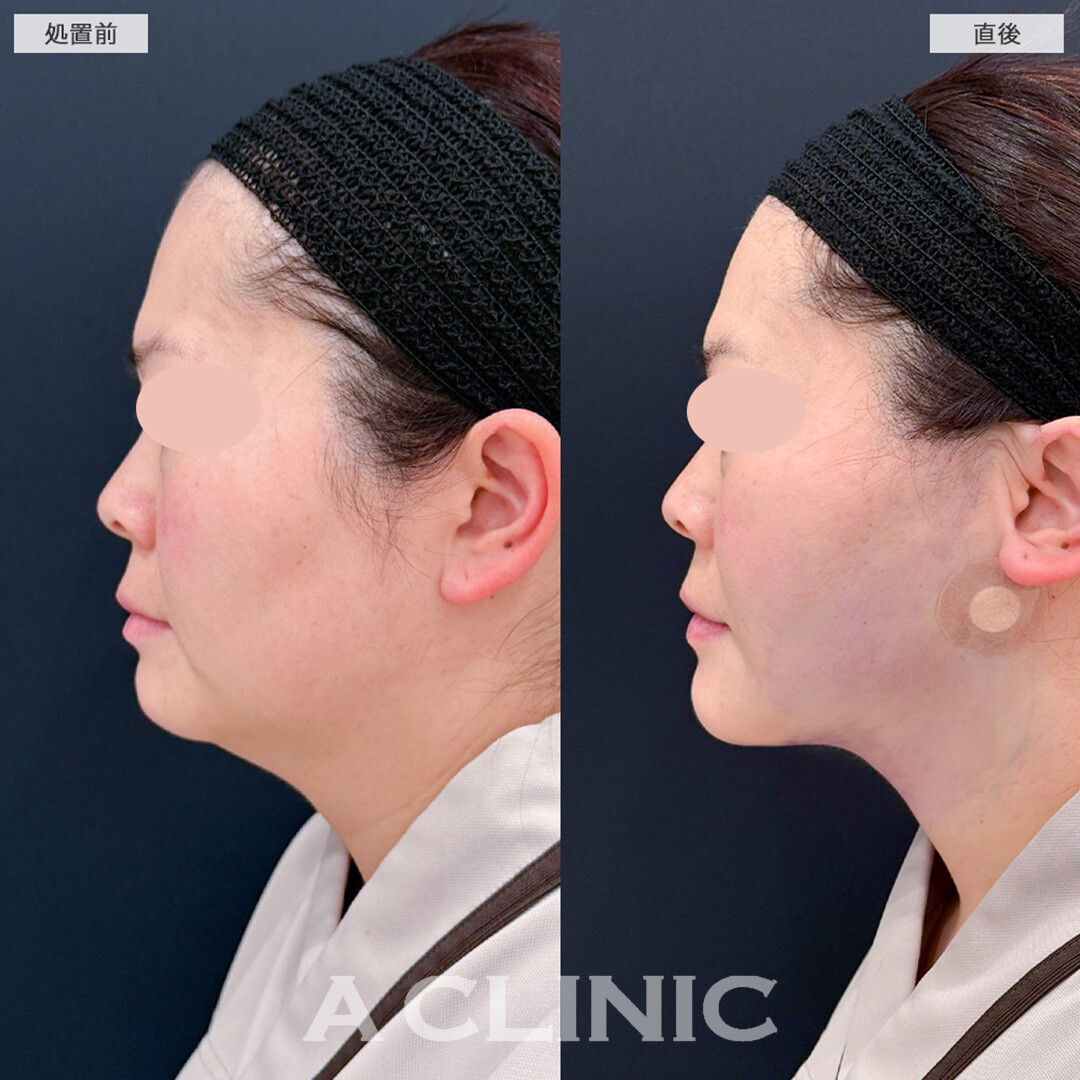1day小顔脂肪吸引はダウンタイム最小限なので忙しいママさんにもおすすめ！こちら処置前と直後の症例です(40代女性)