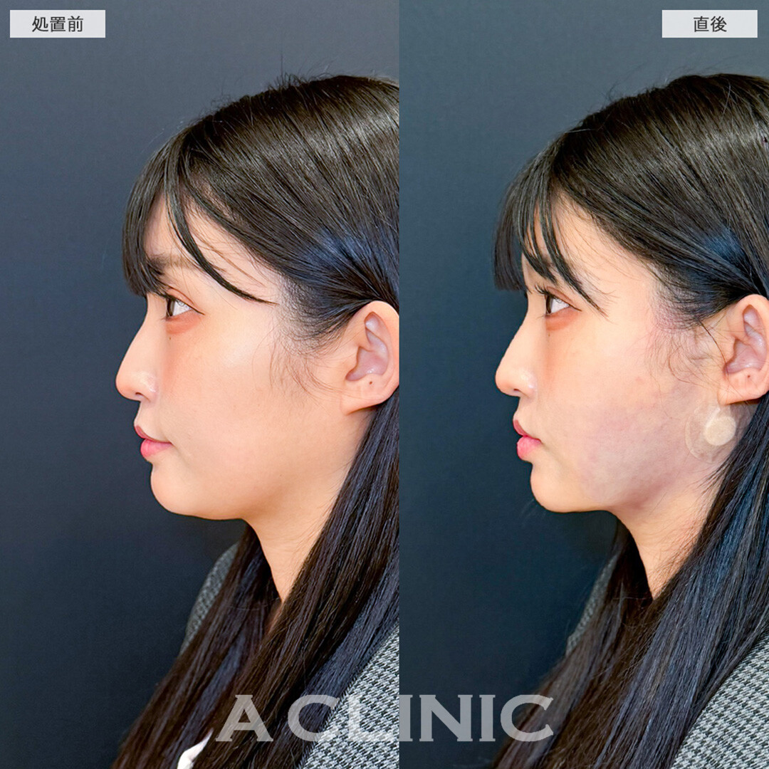 1day小顔脂肪吸引はダウンタイム最小限です！こちら処置前と直後の症例です(30代女性)
