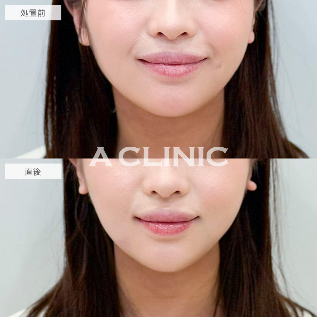 1day小顔脂肪吸引で直後から腫れずに小顔を実感！処置前と直後の症例です(20代女性)