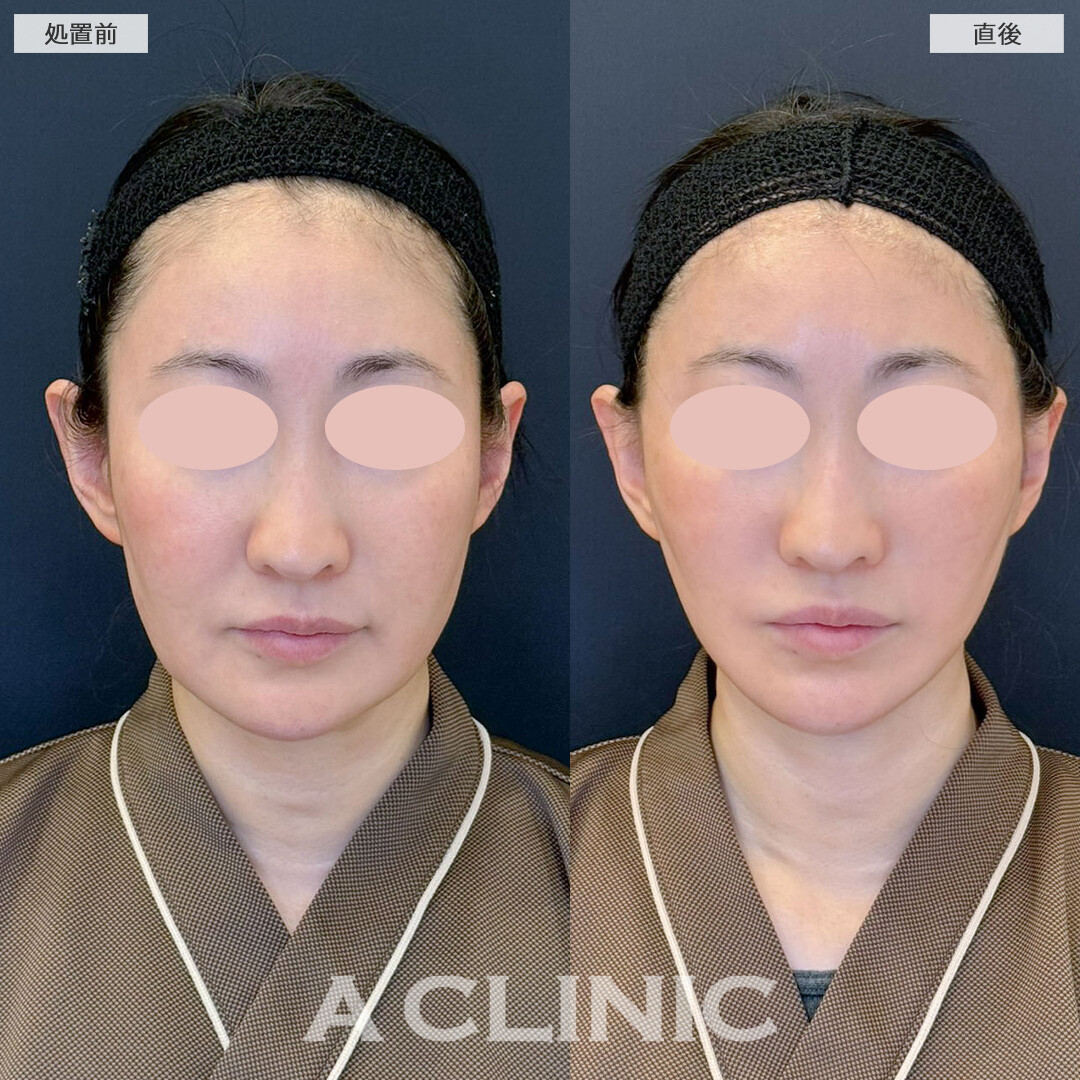 1day小顔脂肪吸引で直後から輪郭がスッキリ変化しました！こちら処置前と直後の症例です(40代女性)