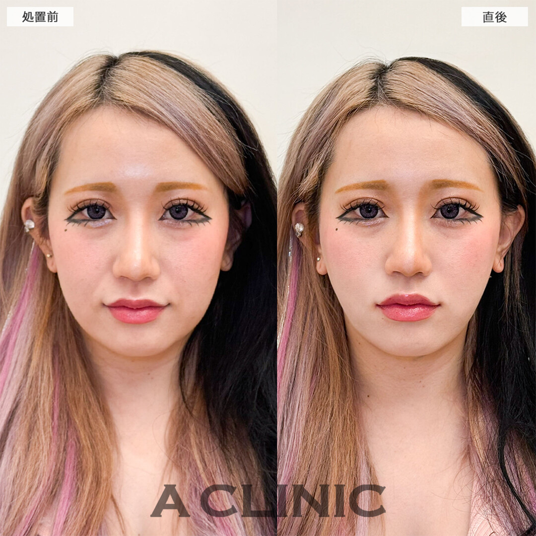 1day小顔脂肪吸引で直後から余分な脂肪がなくなり綺麗な輪郭に！こちら処置前と直後の症例です(30代女性)