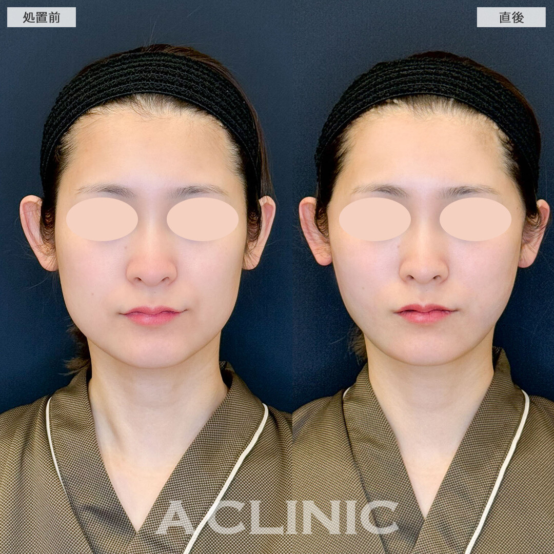1day小顔脂肪吸引で直後から左右差が改善しました！こちら処置前と直後の症例です(30代女性)
