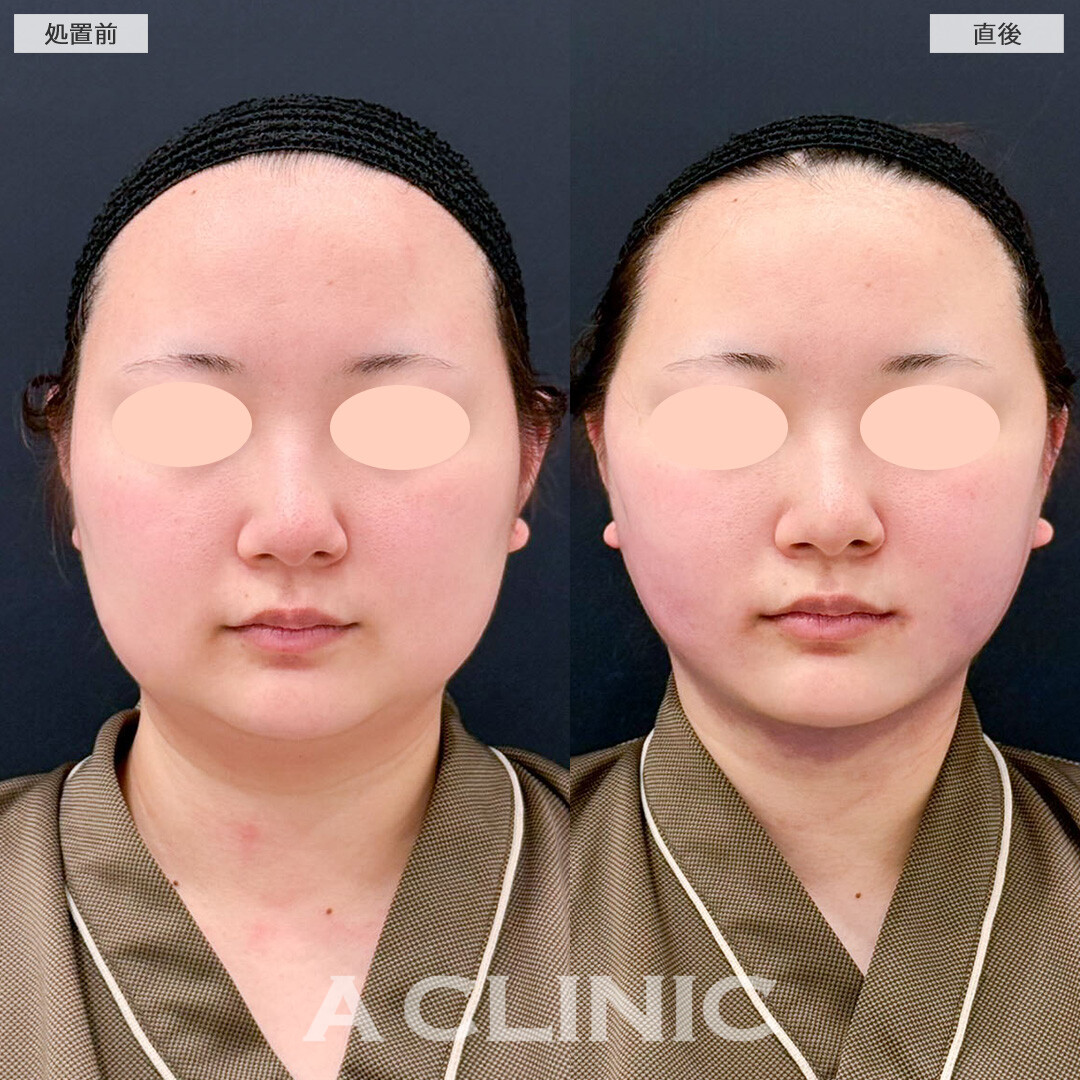 1day小顔脂肪吸引で顔の余白が激減！こちら処置前と直後の症例です(20代女性)
