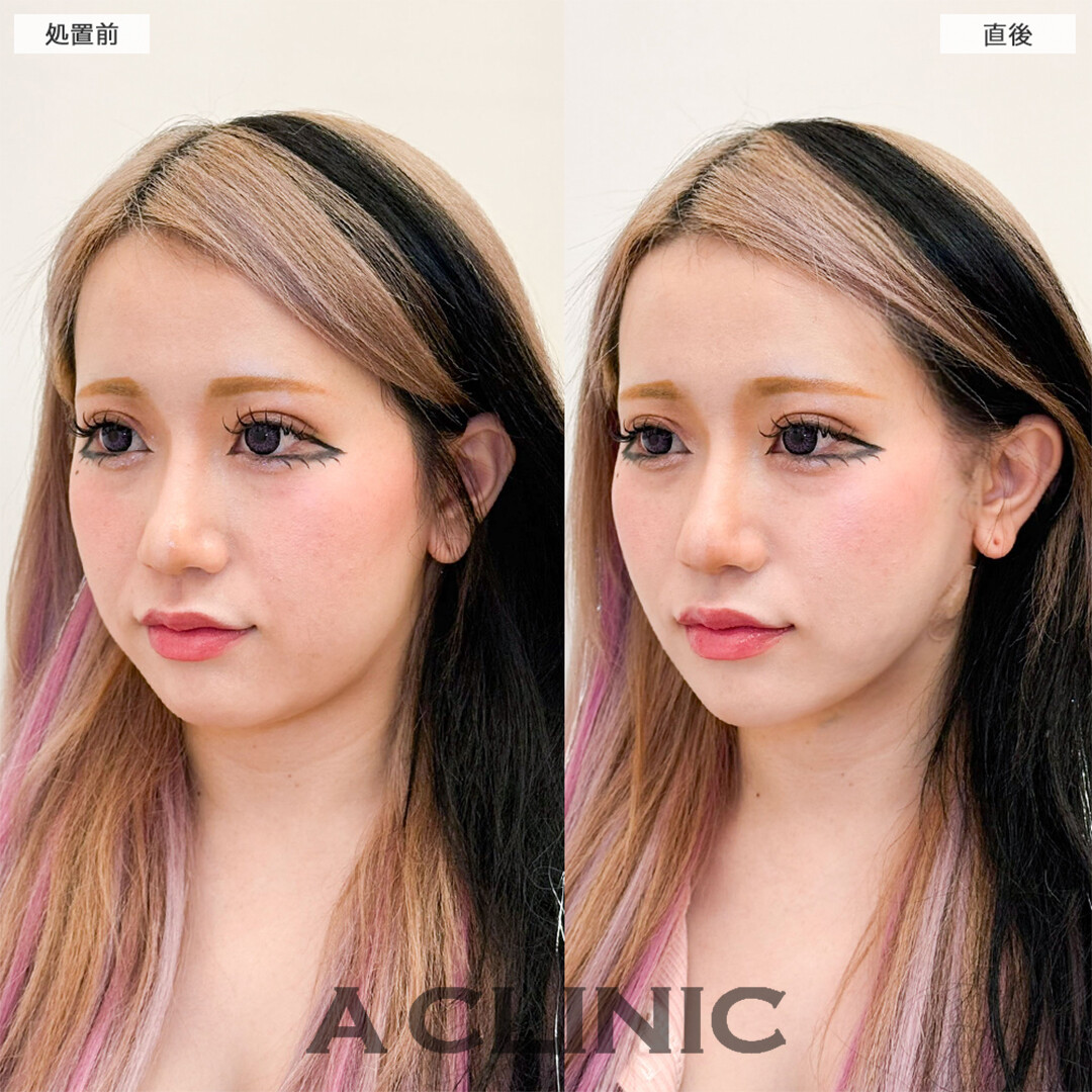 1day小顔脂肪吸引で直後から余分な脂肪がなくなり綺麗な輪郭に！こちら処置前と直後の症例です(30代女性)