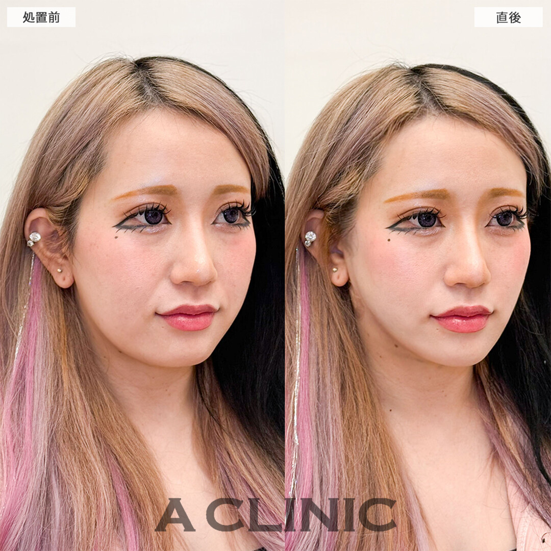1day小顔脂肪吸引で直後から余分な脂肪がなくなり綺麗な輪郭に！こちら処置前と直後の症例です(30代女性)