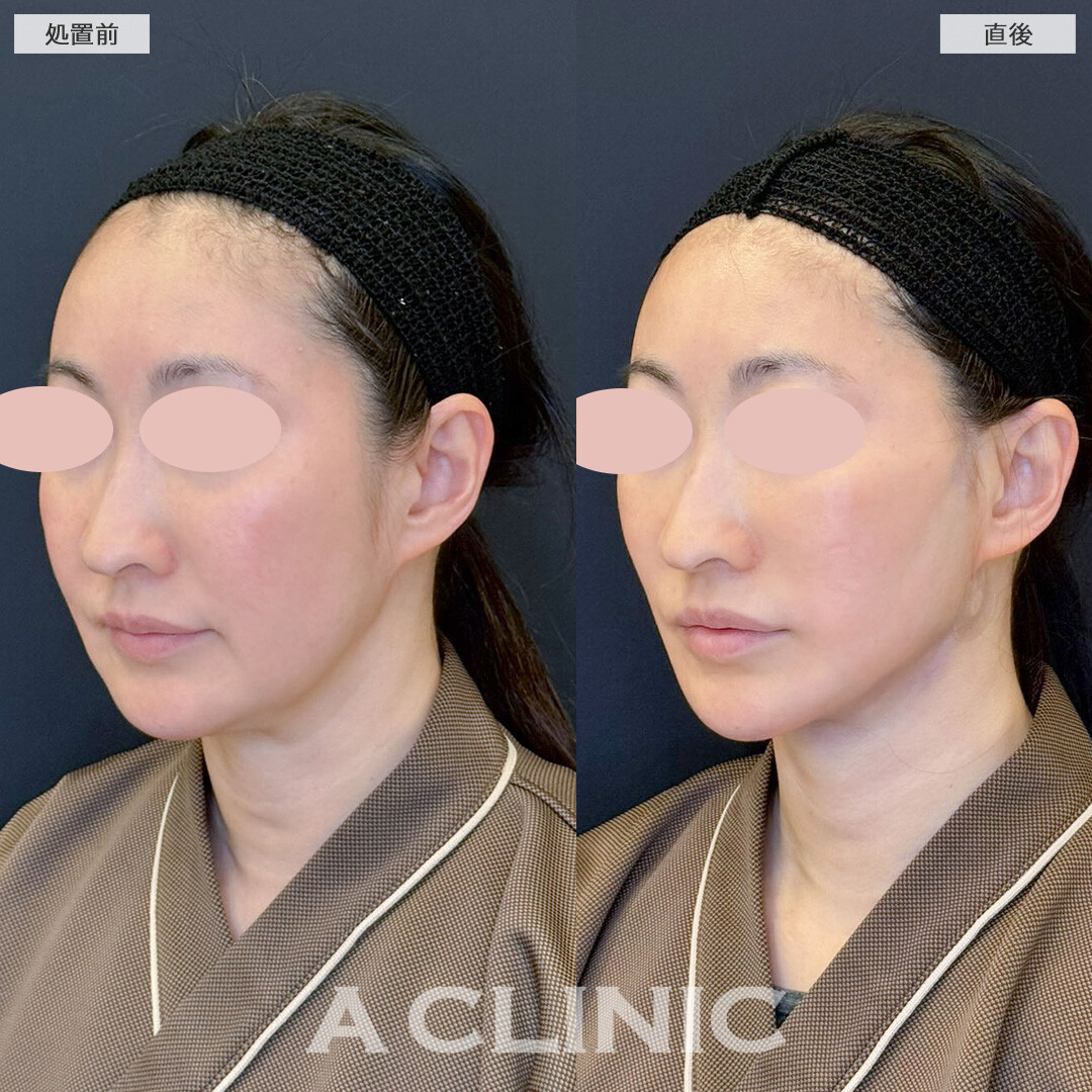 1day小顔脂肪吸引で直後から輪郭がスッキリ変化しました！こちら処置前と直後の症例です(40代女性)