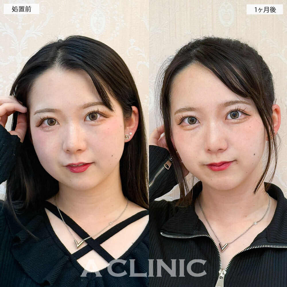 1day小顔脂肪吸引と小顔エラボトックスで可愛さアップデート！こちら処置前と1ヶ月後の症例です(20代女性)