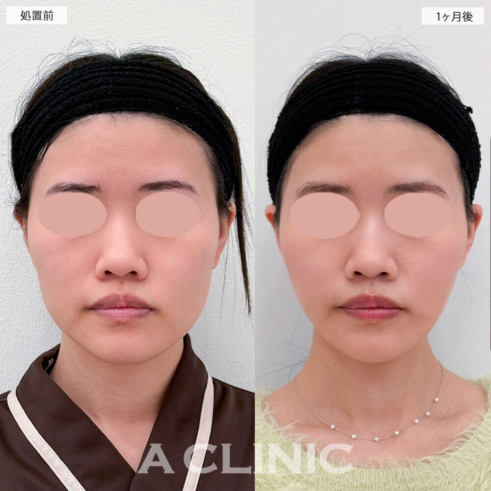 1day小顔脂肪吸引と小顔エラボトックスで輪郭の凸凹感がなくなり整いました！こちら処置前から1ヶ月後の症例です(20代女性)