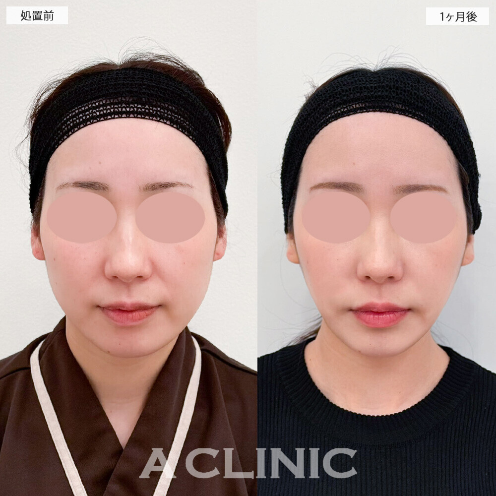 1day小顔脂肪吸引と小顔エラボトックスで綺麗な卵型の輪郭に！こちら処置前と1ヶ月後の症例です(30代女性)