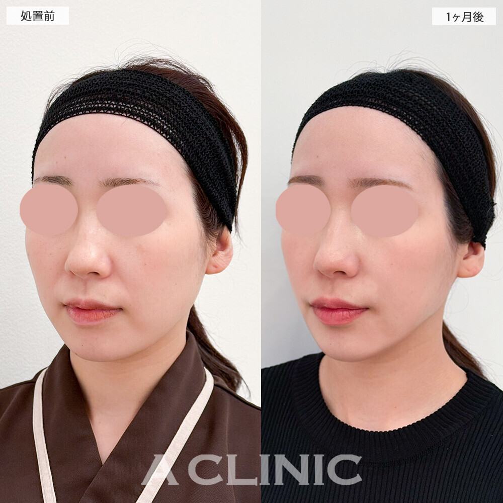 1day小顔脂肪吸引と小顔エラボトックスで綺麗な卵型の輪郭に！こちら処置前と1ヶ月後の症例です(30代女性)