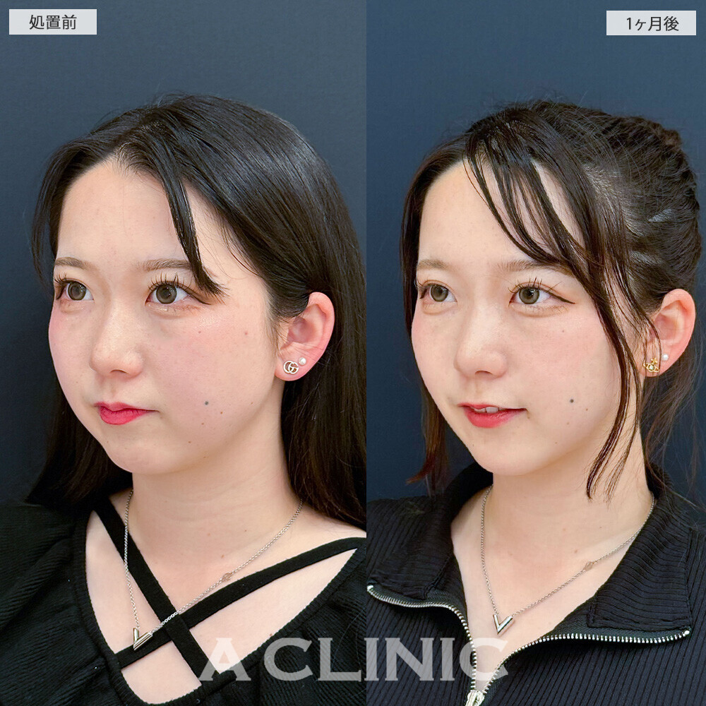 1day小顔脂肪吸引と小顔エラボトックスで可愛さアップデート！こちら処置前と1ヶ月後の症例です(20代女性)