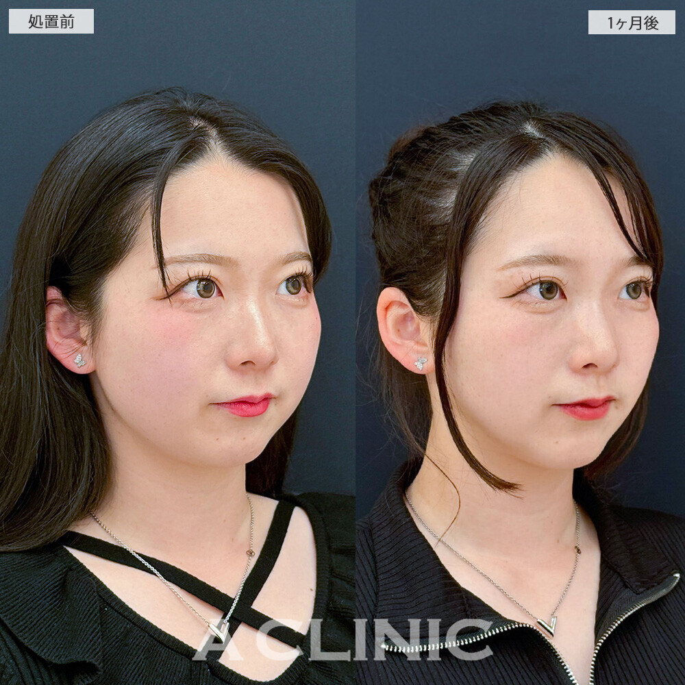 1day小顔脂肪吸引と小顔エラボトックスで可愛さアップデート！こちら処置前と1ヶ月後の症例です(20代女性)