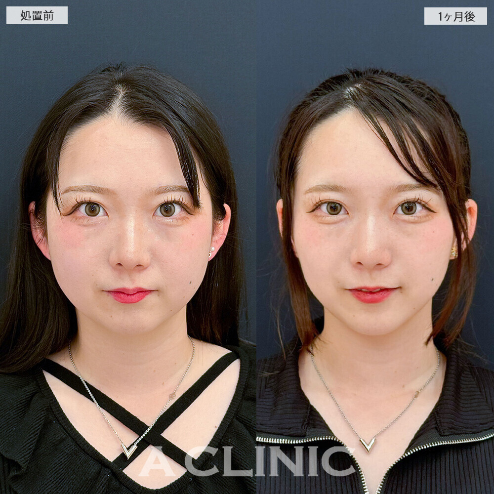 1day小顔脂肪吸引と小顔エラボトックスで可愛さアップデート！こちら処置前と1ヶ月後の症例です(20代女性)