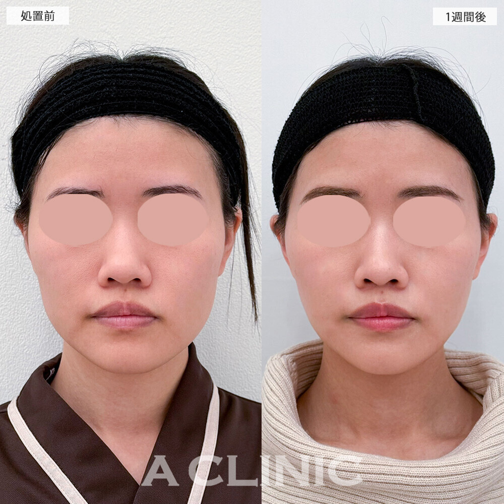 1day小顔脂肪吸引と小顔エラボトックスで輪郭の凸凹感がなくなり整いました！こちら処置前から1ヶ月後の症例です(20代女性)
