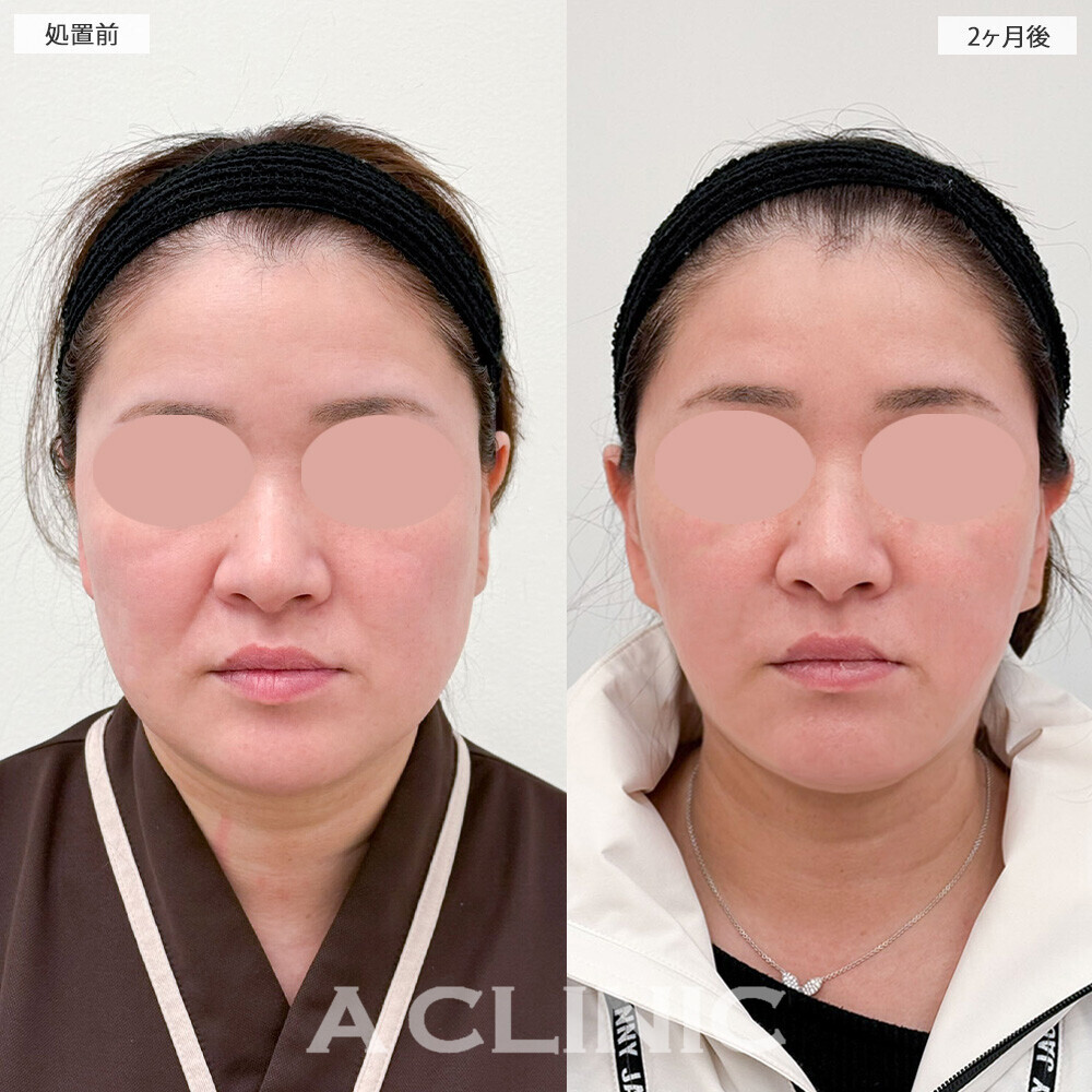 1day小顔脂肪吸引と小顔エラボトックスで下膨れ改善！こちら処置前と2ヶ月後の症例です(40代女性)