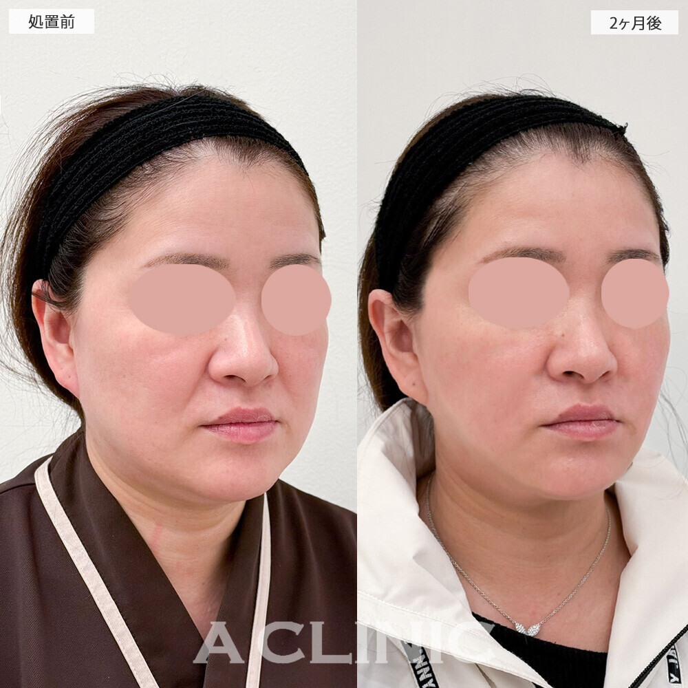 1day小顔脂肪吸引と小顔エラボトックスで下膨れ改善！こちら処置前と2ヶ月後の症例です(40代女性)