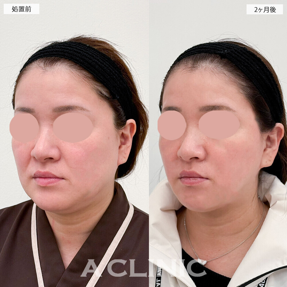 1day小顔脂肪吸引と小顔エラボトックスで下膨れ改善！こちら処置前と2ヶ月後の症例です(40代女性)