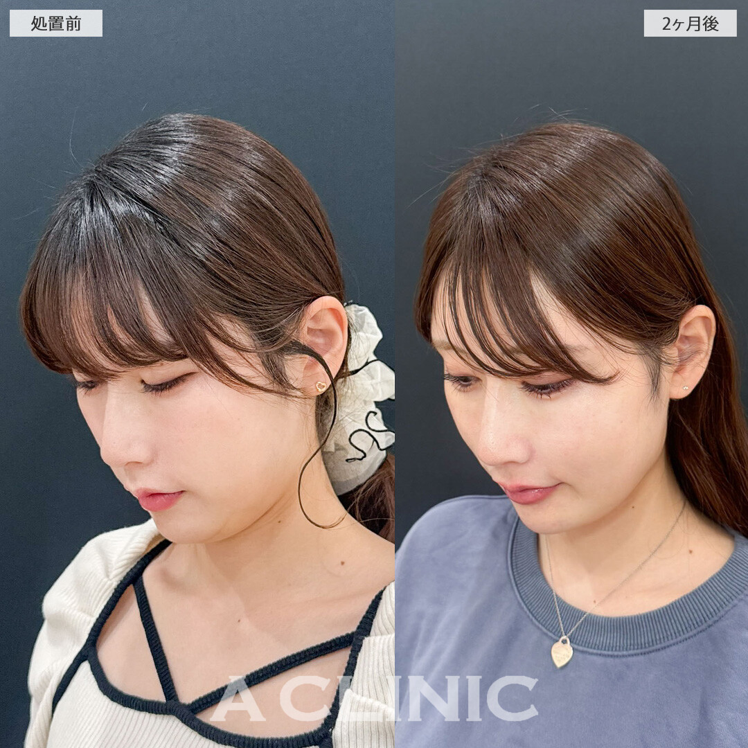 1day小顔脂肪吸引でアゴ下のお肉が減ってスッキリとした輪郭になりました！処置前と2ヶ月後の症例です(30代女性)