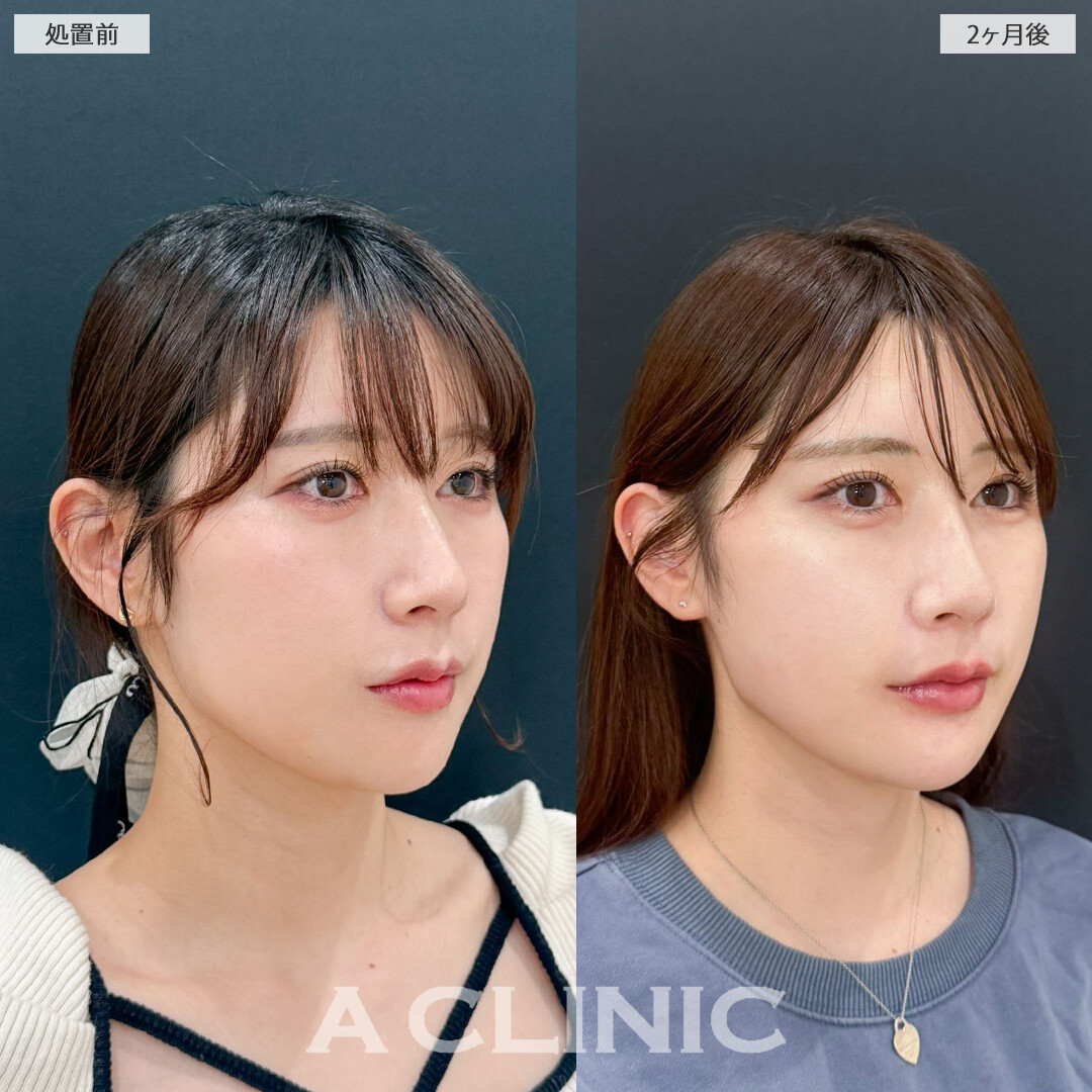 1day小顔脂肪吸引でアゴ下のお肉が減ってスッキリとした輪郭になりました！処置前と2ヶ月後の症例です(30代女性)